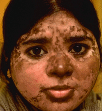 Les raisons de lapparition des taches de pigment sur le cou