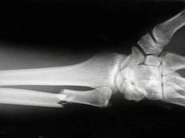 Résultats de recherche d'images pour « radiographie fracture »